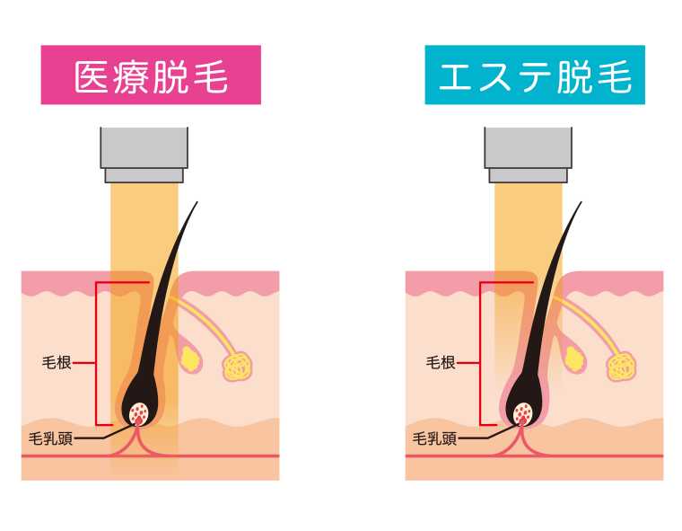 医療脱毛　エステ脱毛