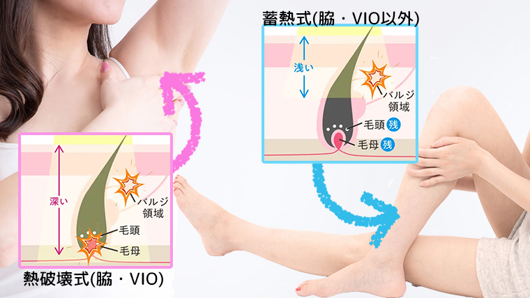 エミナルクリニックの脱毛方式